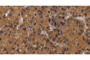Immunohistochemistry of paraffin-embedded Human liver cancer tissue using NPRL2 Polyclonal Antibody at dilution 1:50 (NPRL2 anticorps)