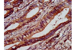 IHC image of ABIN7154230 diluted at 1:1000 and staining in paraffin-embedded human colon cancer performed on a Leica BondTM system.