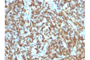 Formalin-fixed, paraffin-embedded human Lymphoma stained with CD45RO Monoclonal Antibody (SPM125). (CD45 anticorps)