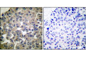 Immunohistochemical analysis of paraffin-embedded human breast carcinoma tissue using PLCG1 (Ab-771) antibody. (Phospholipase C gamma 1 anticorps)