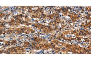 Immunohistochemistry of paraffin-embedded Human gasrtic cancer tissue using CD13 Polyclonal Antibody at dilution 1:80 (CD13 anticorps)