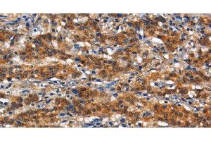 Immunohistochemistry of paraffin-embedded Human gasrtic cancer tissue using CD13 Polyclonal Antibody at dilution 1:80