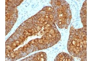 IHC testing of FFPE human colon carcinoma with MAML3 antibody (clone MAML3/1303). (MAML3 anticorps)