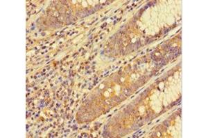 Immunohistochemistry of paraffin-embedded human colon cancer using ABIN7153793 at dilution of 1:100 (GTF2F1 anticorps  (AA 1-249))