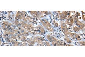 Immunohistochemistry of paraffin-embedded Human breast cancer tissue using CXCL5 Polyclonal Antibody at dilution of 1:45(x200) (CXCL5 anticorps)