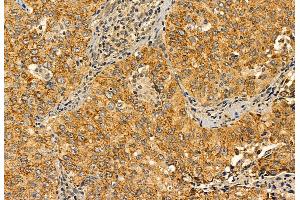 ABIN6264534 and ABIN6272895 at 1/100 staining Human lung cancer by IHC-P. (PYCR1 anticorps  (Internal Region))