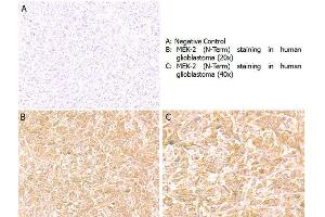 Immunohistochemistry with anti-MEK2 (N-Term) antibody showing positive staining in human glioblastoma tissue at 20x and 40x (B & C).