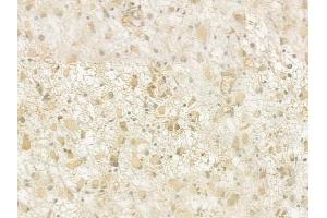 ABIN6261305 and ABIN6276929 at 1/100 staining human glioblastoma by IHC-P. (DKC1 anticorps  (Internal Region))