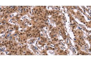 Immunohistochemistry of paraffin-embedded Human gasrtic cancer tissue using ID4 Polyclonal Antibody at dilution 1:40