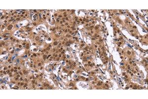Immunohistochemistry of paraffin-embedded Human gasrtic cancer tissue using ID4 Polyclonal Antibody at dilution 1:40 (ID4 anticorps)