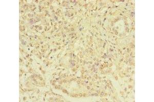 Immunohistochemistry of paraffin-embedded human pancreatic cancer using ABIN7169347 at dilution of 1:100 (SERPINB6 anticorps  (AA 180-300))