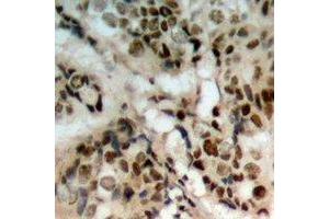 Immunohistochemical analysis of PTEN (pS380/T382/T383) staining in human prostate cancer formalin fixed paraffin embedded tissue section. (PTEN anticorps  (C-Term, pSer380, pThr382, pThr383))