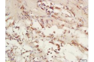 Formalin-fixed and paraffin embedded human laryngeal carcinoma labeled with Rabbit Anti-COX6c/Cytochrome C Oxidase subunit VIc Polyclonal Antibody, Unconjugated (ABIN1714715) at 1:200 followed by conjugation to the secondary antibody and DAB staining (COX6C anticorps  (AA 21-75))