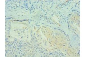 Immunohistochemistry of paraffin-embedded human breast cancer using ABIN7164694 at dilution of 1:100 (PDCD4 anticorps  (AA 1-260))