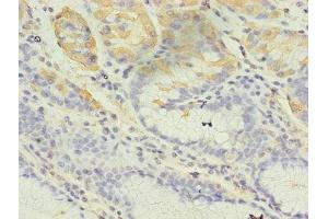 Immunohistochemistry of paraffin-embedded human gastric cancer using ABIN7148027 at dilution of 1:100 (CBLIF (AA 19-417) anticorps)