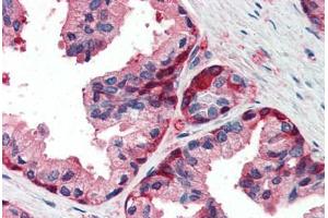 Human Prostate (formalin-fixed, paraffin-embedded) stained with GSTP1 antibody ABIN337104 at 5 ug/ml followed by biotinylated anti-goat IgG secondary antibody ABIN481715, alkaline phosphatase-streptavidin and chromogen. (GSTP1 anticorps  (AA 22-33))
