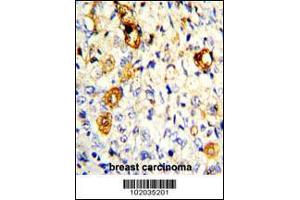 Formalin-fixed and paraffin-embedded human breast carcinoma with MMP19 Antibody , which was peroxidase-conjugated to the secondary antibody, followed by DAB staining. (MMP19 anticorps  (C-Term))