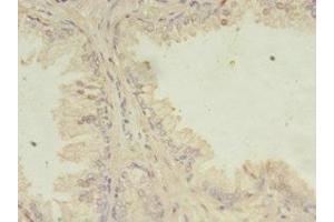 Immunohistochemistry of paraffin-embedded human prostate cancer using ABIN7165657 at dilution of 1:100 (ITPRID2 (AA 1-267) anticorps)