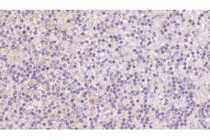 ABIN6273093 at 1/100 staining Human lymph cancer tissue by IHC-P.