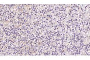 ABIN6273093 at 1/100 staining Human lymph cancer tissue by IHC-P. (BBS7 anticorps  (Internal Region))