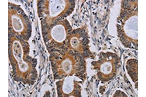 The image on the left is immunohistochemistry of paraffin-embedded Human colon cancer tissue using ABIN7191791(PARP8 Antibody) at dilution 1/40, on the right is treated with synthetic peptide. (PARP8 anticorps)