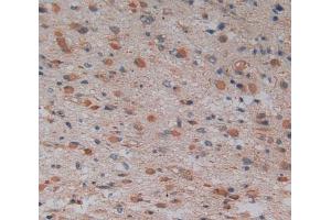 Used in DAB staining on fromalin fixed paraffin- embedded glioma tissue