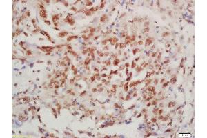 Formalin-fixed and paraffin embedded human lung carcinoma labeled with Rabbit Anti-BTK (Tyr223) Polyclonal Antibody, Unconjugated  at 1:200 followed by conjugation to the secondary antibody and DAB staining