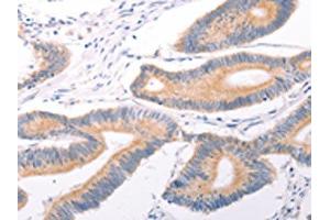 The image on the left is immunohistochemistry of paraffin-embedded Human colon cancer tissue using ABIN7131495(TRPC7 Antibody) at dilution 1/25, on the right is treated with fusion protein.