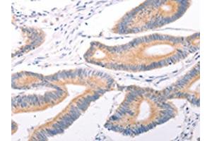 The image on the left is immunohistochemistry of paraffin-embedded Human colon cancer tissue using ABIN7131495(TRPC7 Antibody) at dilution 1/25, on the right is treated with fusion protein. (TRPC7 anticorps)
