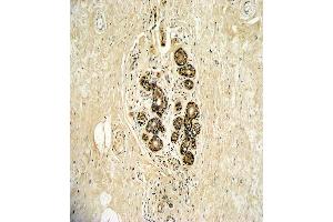 Formalin-fixed and paraffin-embedded human breast carcinoma with ErbB3 Antibody (N-term), which was peroxidase-conjugated to the secondary antibody, followed by DAB staining.