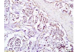 Formalin-fixed and paraffin embedded human gastric carcinoma labeled with Anti-SIRT1 Polyclonal Antibody, Unconjugated  at 1:200, followed by conjugation to the secondary antibody and DAB staining (SIRT1 anticorps  (AA 101-200))