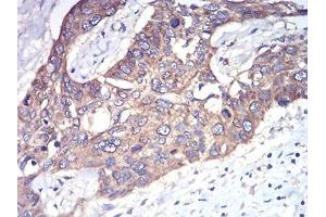 Immunohistochemical analysis of paraffin-embedded esophageal cancer tissues using Rab1b mouse mAb with DAB staining.