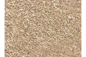 DNase I Mouse Monoclonal Antibody at 1/100 staining human gastric cancer by IHC-P.