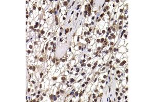 Immunohistochemistry of paraffin-embedded human kidney cancer using DDX21 antibody (ABIN5974230) at dilution of 1/100 (40x lens). (DDX21 anticorps)
