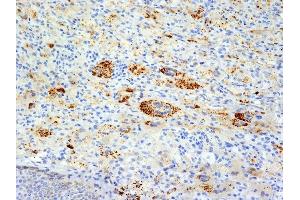 Formalin-fixed, paraffin-embedded human Erdheim-Chester disease (also known as polyostotic sclerosing histiocytosis) stained with TNF alpha Mouse Monoclonal Antibody (TNFA/1172). (TNF alpha anticorps)