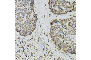 Immunohistochemistry of paraffin-embedded human esophageal cancer using CD62P/P-selectin antibody (ABIN6131514, ABIN6147503, ABIN6147506 and ABIN6218519) at dilution of 1:100 (40x lens). (P-Selectin anticorps  (AA 30-200))