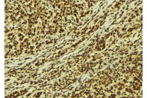 ABIN6269328 at 1/100 staining Human breast cancer tissue by IHC-P. (PKC delta anticorps  (C-Term))