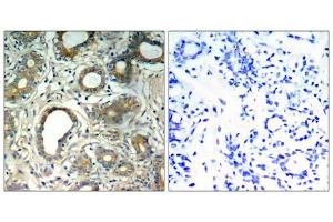 Immunohistochemical analysis of paraffin-embedded human breast carcinoma tissue, using SHP-2 (Phospho-Tyr580) antibody (E011320). (PTPN11 anticorps  (pTyr580))