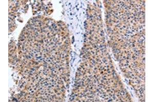 The image on the left is immunohistochemistry of paraffin-embedded Human liver cancer tissue using ABIN7131299(TAT Antibody) at dilution 1/35, on the right is treated with fusion protein. (Tat anticorps)