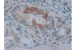 Detection of NT5C3 in Human Lung cancer Tissue using Polyclonal Antibody to 5'-Nucleotidase, Cytosolic III (NT5C3)