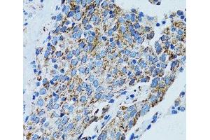 Immunohistochemistry of paraffin-embedded Human lung cancer using MRPL28 Polyclonal Antibody at dilution of 1:100 (40x lens). (MRPL28 anticorps)