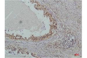Immunohistochemistry (IHC) analysis of paraffin-embedded Human Lung Carcinoma using IkappaB beta(Mouse Monoclonal Antibody diluted at 1:200. (NFKBIB anticorps)