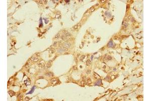 Immunohistochemistry of paraffin-embedded human pancreatic cancer using ABIN7165454 at dilution of 1:100 (FAM187B anticorps  (AA 18-335))
