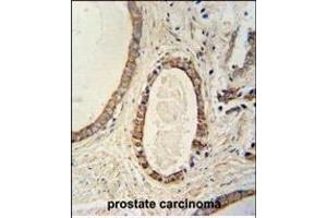 TME antibody (N-term) (ABIN654026 and ABIN2843945) immunohistochemistry analysis in formalin fixed and paraffin embedded human prostate carcinoma followed by peroxidase conjugation of the secondary antibody and DAB staining. (TMEM214 anticorps  (N-Term))