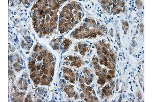 Immunohistochemical staining of paraffin-embedded Carcinoma of liver tissue using anti-DCXRmouse monoclonal antibody. (DCXR anticorps)