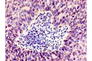 Immunohistochemistry of paraffin-embedded human cervical cancer using ABIN7171071 at dilution of 1:100 (SMARCD1 anticorps  (AA 7-124))