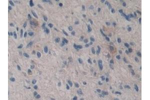 Detection of GSTt2 in Human Glioma Tissue using Polyclonal Antibody to Glutathione S Transferase Theta 2 (GSTt2)