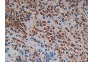 Detection of MASP1 in Human Colorectal cancer Tissue using Polyclonal Antibody to Mannose Associated Serine Protease 1 (MASP1)