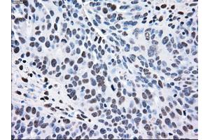Immunohistochemical staining of paraffin-embedded Adenocarcinoma of breast tissue using anti-MAP2K2 mouse monoclonal antibody. (MEK2 anticorps)