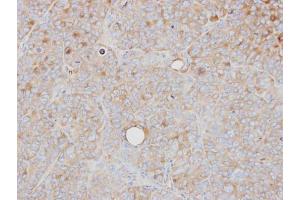 IHC-P Image Immunohistochemical analysis of paraffin-embedded SW480 xenograft, using PRPS1, antibody at 1:500 dilution.